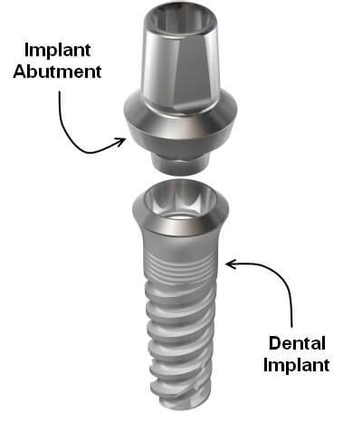 Dental Implant Abutments-Glendale Implant Dentist