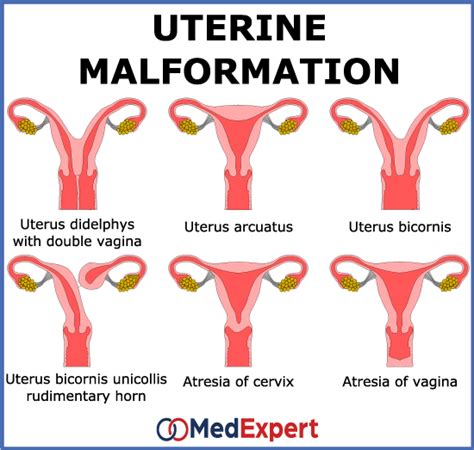 Abnormal uterus anatomy treatment and pregnancy | MED Expert