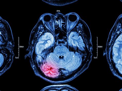 Hippocampal Atrophy in Depression Not Necessarily Alzheimer’s