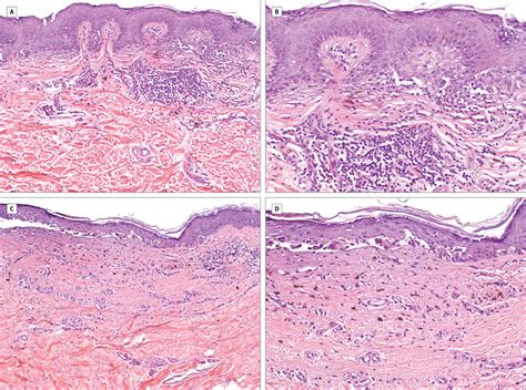 Atypical (Dysplastic) Nevi: Outcomes of Surgical Excision and Association With Melanoma ...