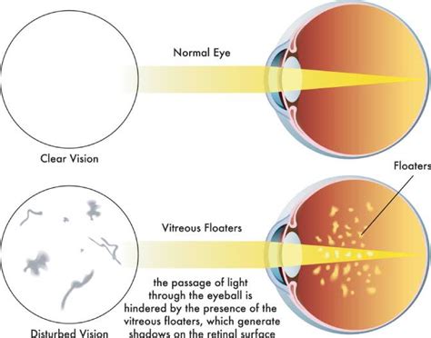 Eye Floater Treatment | Nationwide Vision