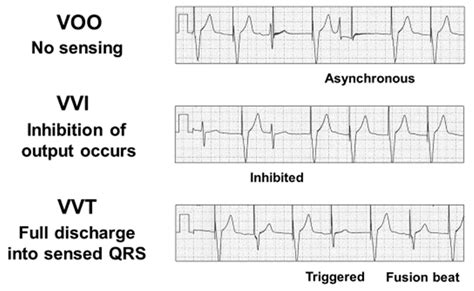 Single Chamber Ventricular Pacing - Resources