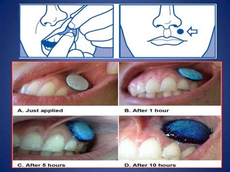 Buccal drug delivery system