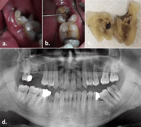 Mandibular Third Molar