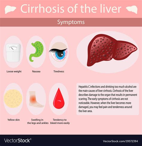 Symptoms infectious mononucleosis Royalty Free Vector Image