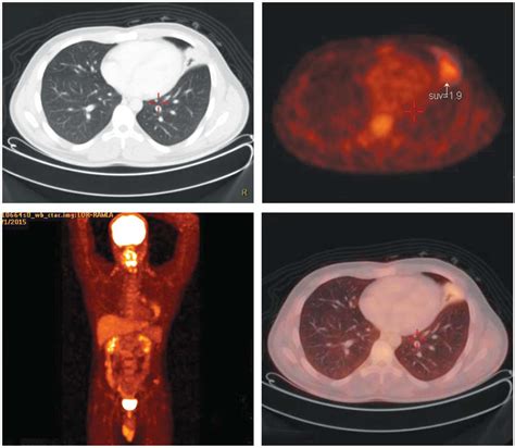 A Case of Lung Carcinoid Tumor, Successfully Treated with Bronchoscopic Cryosurgery in Thailand