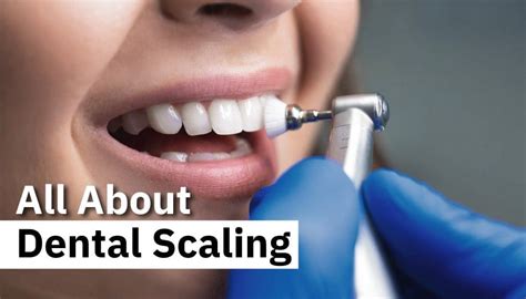 All About Dental Scaling | Dental Assets | DentalAssets.com - Newport Beach, CA