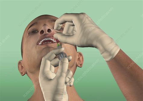 Infraorbital nerve block, artwork - Stock Image - C016/6818 - Science ...