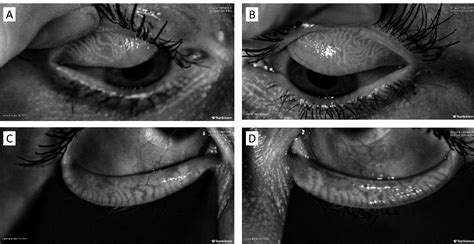 Case Study: Utilizing Meibography to Address Contact Lens Intolerance | Contact Lens Update