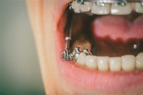 Dental Appliance and Braces Stock Image - Image of health, face: 105689495