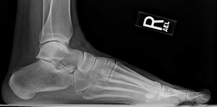 Anterior Calcaneus Fracture