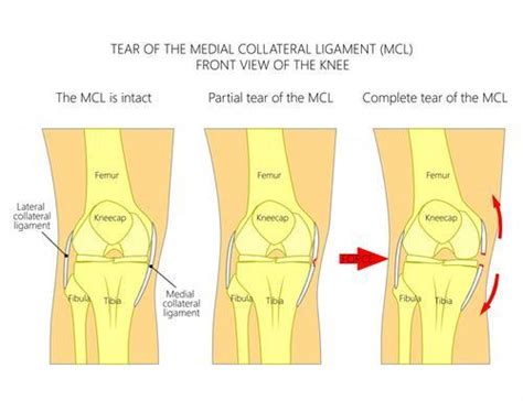 MCL Tears: Elite Sports Medicine + Orthopedics: Orthopedics