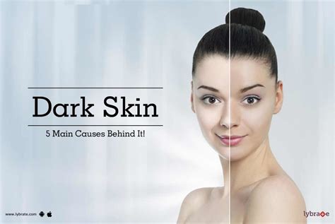 Dark Skin - 5 Main Causes Behind It! - By Dr. Vivek Mehta | Lybrate