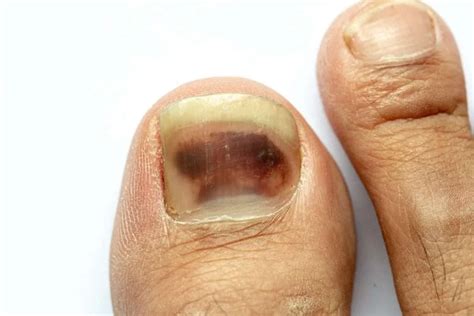 Common Nail Conditions | Diagnosis and Treatment Options