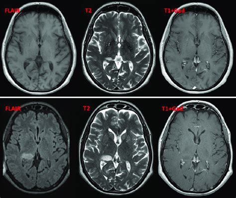 Case 2. Upper: Eight years after the initial MS diagnosis, MRI reveals ...