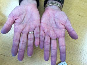 Cyanosis - Physiopedia