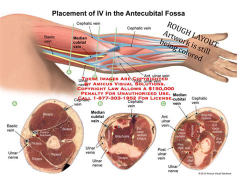 AMICUS Illustration of amicus,medical,arm,IV,placement,antecubital,fossa,baslic,vein,cubital ...