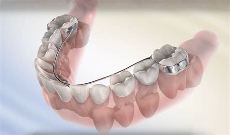 Lower Lingual Holding Arch Appliance Explained - iDentity Orthodontics