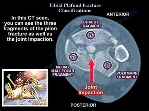 Tibial Plafond Fracture Classification - Everything You Need To Know ...