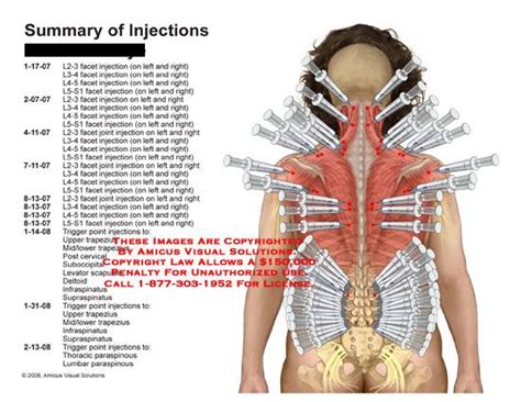 Summary of Injections