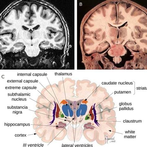 Brain Hippocampus Coronal