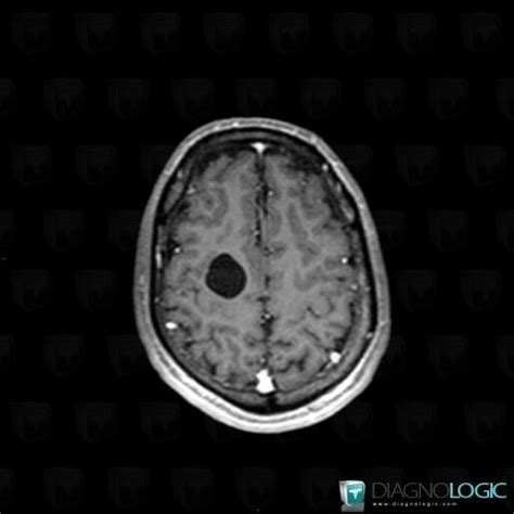 Radiology case : Neuroglial cyst (MRI) - Diagnologic