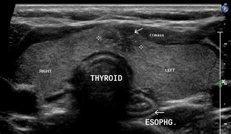 Thyroid Nodules - Oncology - Medbullets Step 2/3