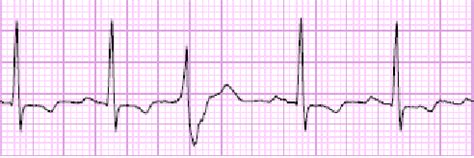 Premature ventricular complex with a compensatory pause 3.2.8 Work-up ...