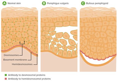 Bullous Pemphigoid and Pemphigus Vulgaris | Concise Medical Knowledge