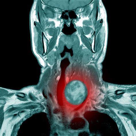 ¿Hay tratamiento para la peste bubónica? | Salud180