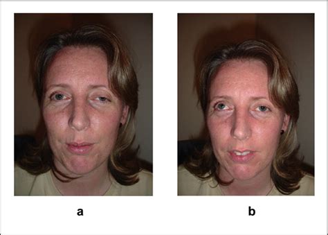 Ophthalmoplegic migraine: The case for reclassification - R Lane, P Davies, 2010