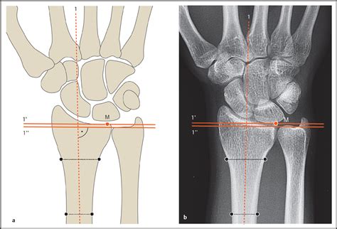 Ulnar Deviation X Ray