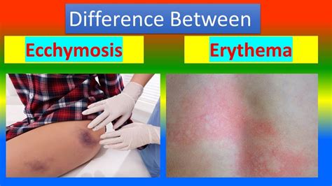 Difference between Ecchymosis and Erythema - YouTube