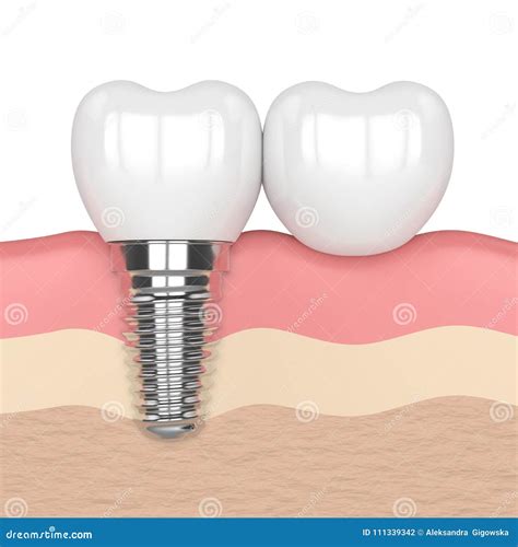 3d Render of Implant with Dental Cantilever Bridge Stock Illustration ...