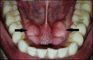 Torus Mandibularis | The American Journal of Medicine Blog