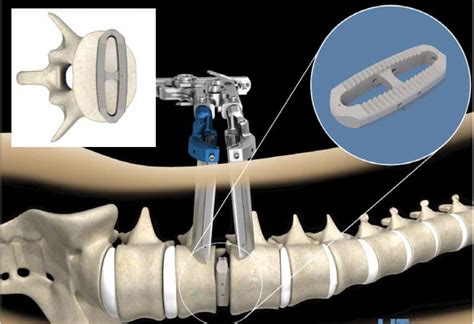 Extreme-Lateral Lumbar Interbody Fusion | XLIF | Dr. Paul Jeffords, MD