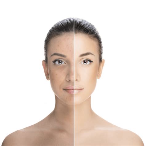 Hyperpigmentation & Sun Damage Treatment in Bexhill, East Sussex