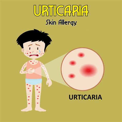 Itchy bumps on skin: Urticaria or hives in children - Dr. Ankit Parakh