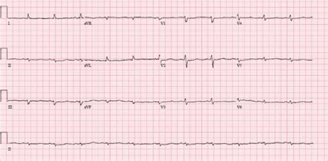 EKG showing low voltage and sinus bradycardia. | Download Scientific Diagram