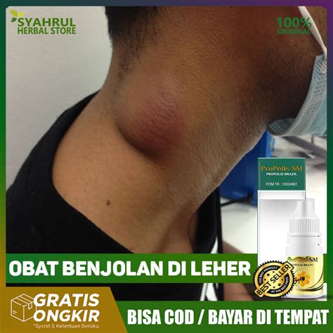 Obat Benjolan Di Leher - Infeksi Kelenjar - Tiroid - Benjolan Lipoma - Obat Kelenjar Getah ...