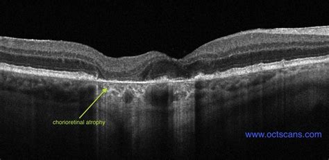 Age-Related Macular Degeneration - Optical Coherence Tomography Scans