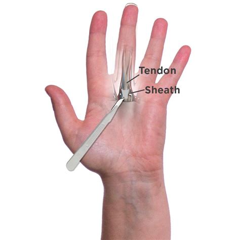 What Are the Surgery Options to Treat My Trigger Finger? | Trigger finger treatment, Trigger ...