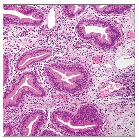 Cystitis Cystica and Glandularis | Basicmedical Key