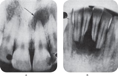 10: Diseases of the Pulp and Periapical Tissues | Pocket Dentistry