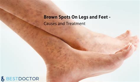 Brown Spots On Legs and Feet - Causes and Treatment