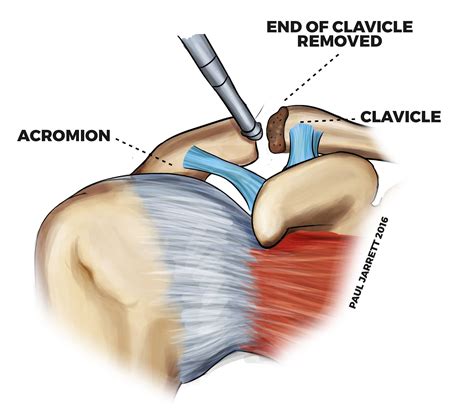 Acromioclavicular Joint Arthritis - Dr Paul Jarrett, Orthopaedic Surgeon Perth