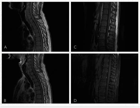 MRI cervical, thoracic, and lumbar spine with and without contrast A ...