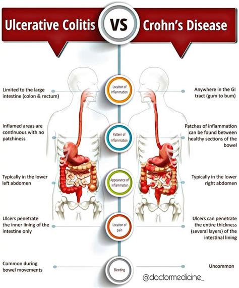 Difference between ulcerative colitis and crohn s disease – Artofit