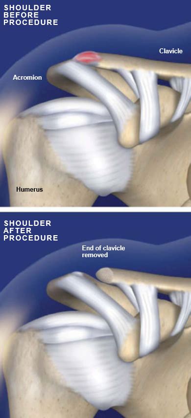 Distal Clavicle Excision (Resection) | Central Coast Orthopedic Medical ...