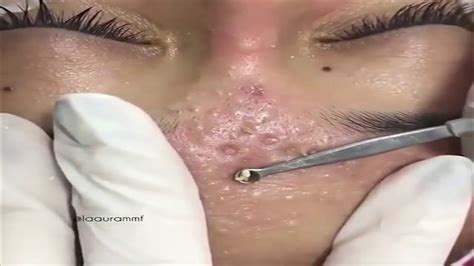 Pimple Popping Videos 2024 Blackheads Removal Youtube - Lina Shelby